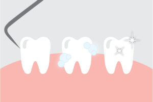 Teeth Cleaning Illustration